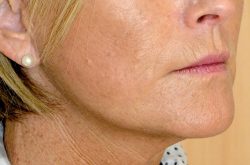 face lift post1 - Copy